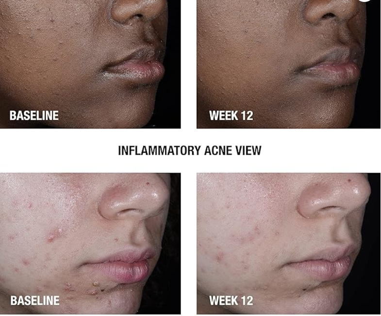 Neutrogena results on acne prone skin